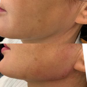 Cheek Fillers Before and after | Dr Mohsin | Beyond MediSpa