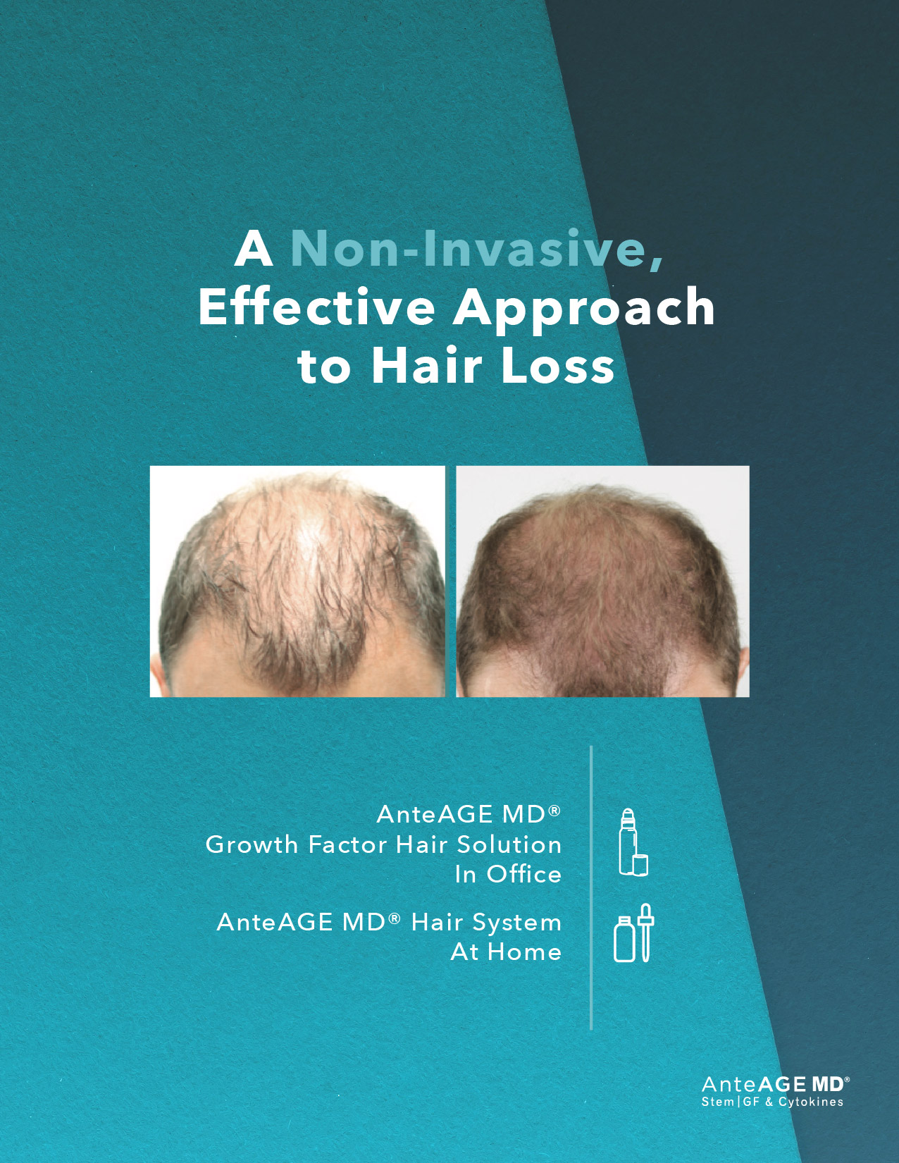 AnteAGE MD® Hair Growth Factor Solution | London | Beyond Medispa
